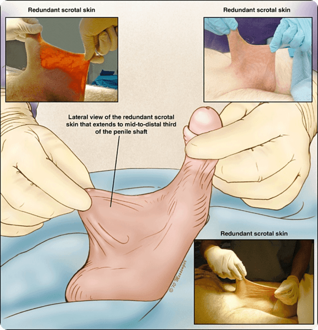 penile extension image