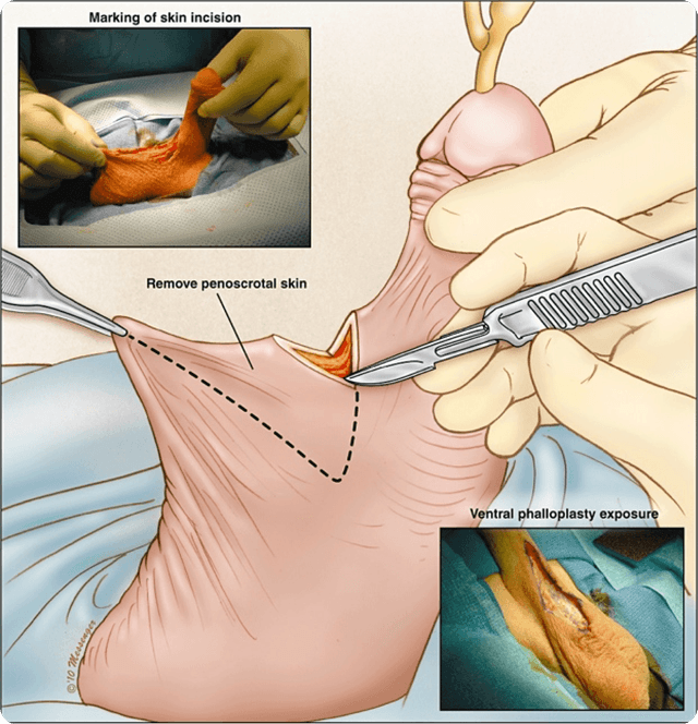 penile extension image