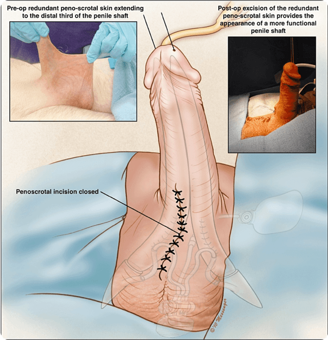 penile extension image